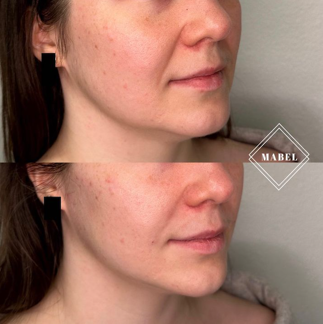 Leuan ja leukalinjan hoito täyteaineella