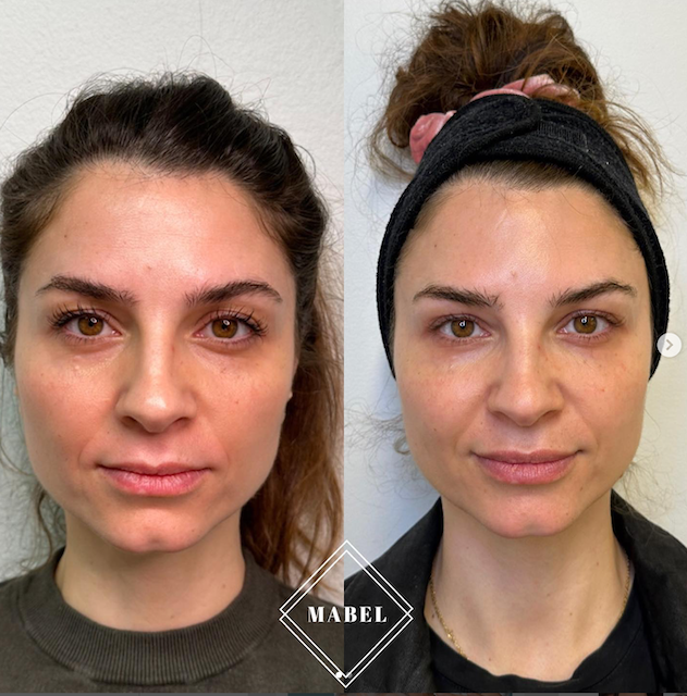 Poskien ja kyynelurien täyteainehoito