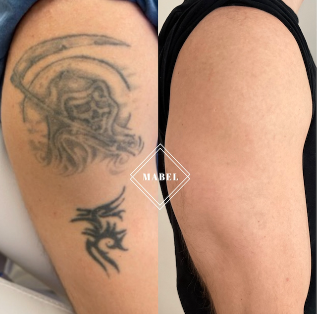 Tatuoinnin poisto laserilla Mabel