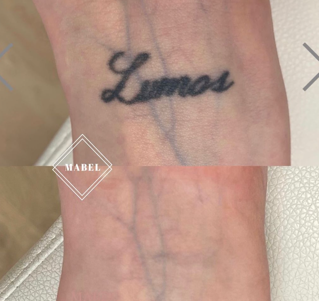 Tatuoinnin poisto laserilla Mabel