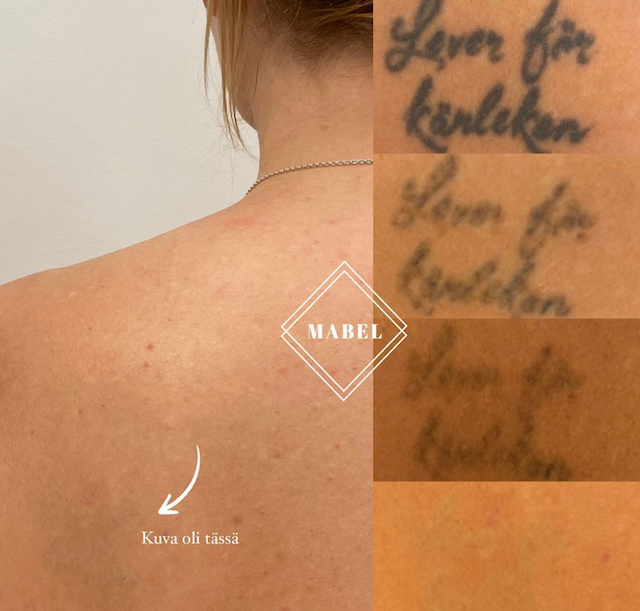 Tatuoinnin poisto laserilla Mabel