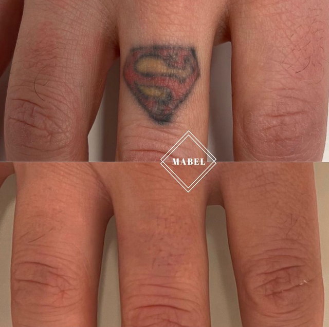 Tatuoinnin poisto laserilla Mabel