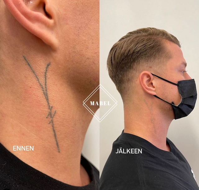 Tatuoinnin poisto laserilla Mabel