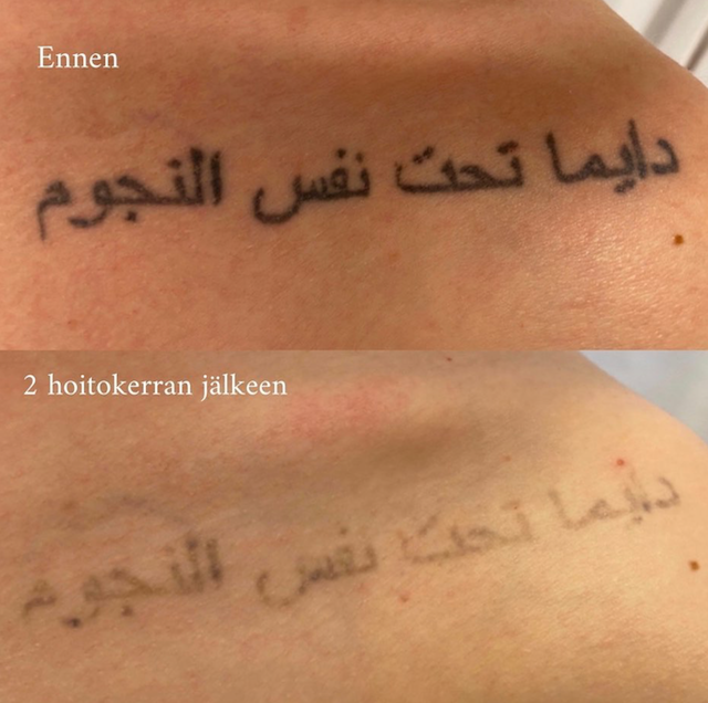 Tatuoinnin poisto laserilla Mabel