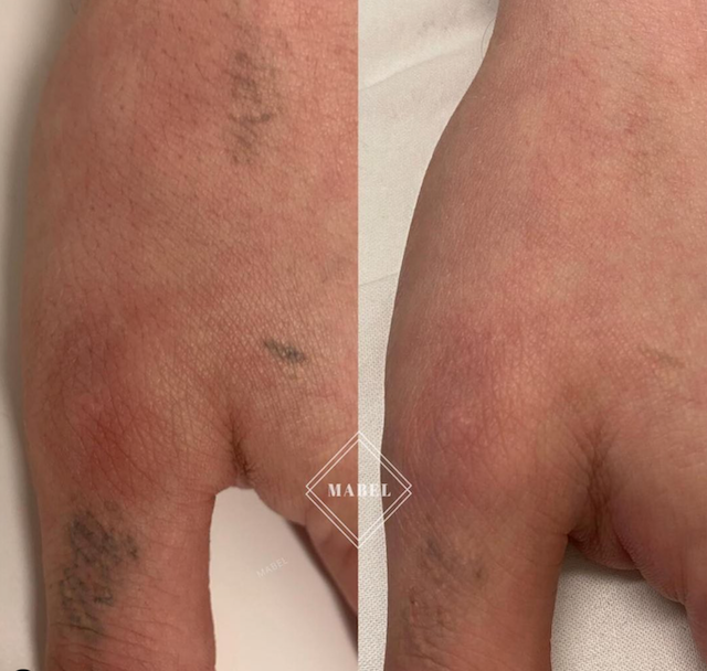 Tatuoinnin poisto laserilla Mabel