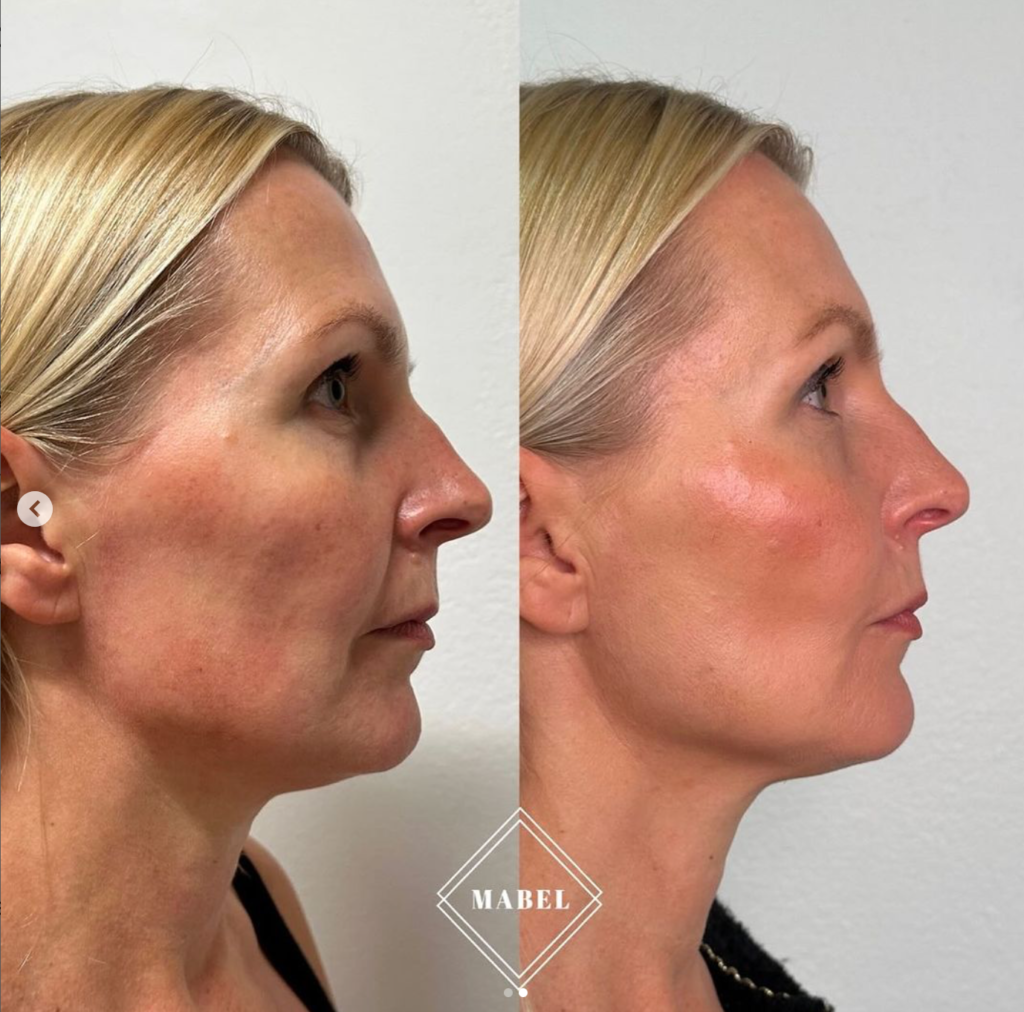 Ikämuutosten hoito HArmonyCa hoito