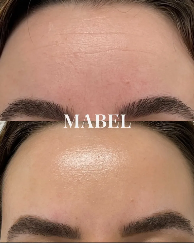 Otsan botoxhoito -botuliinihoito -ryppyjen poisto