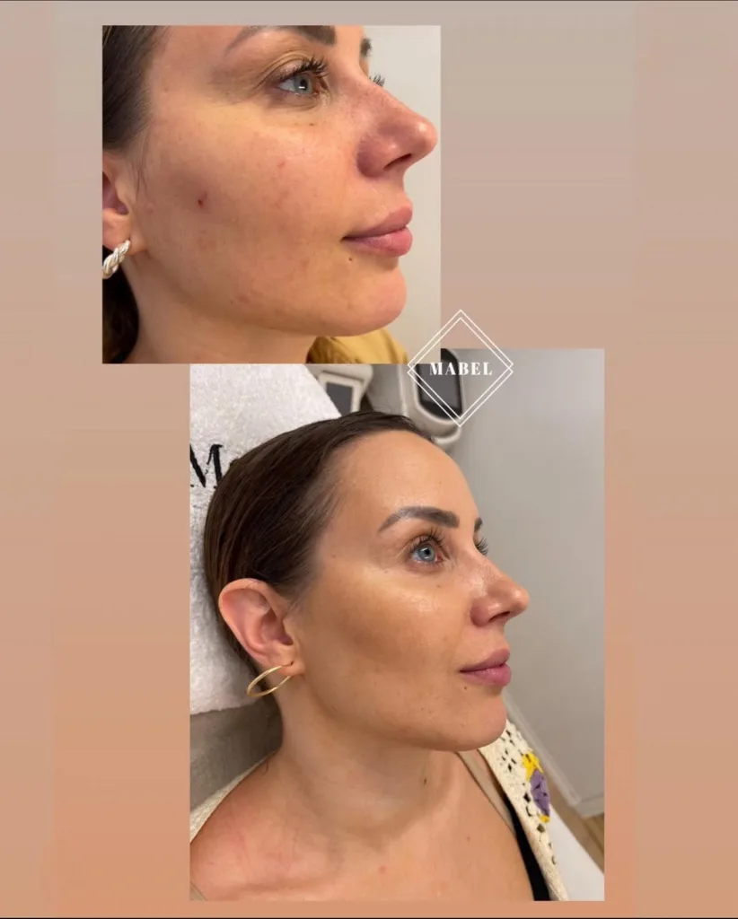 Profhilo hyaluronihappo, ihon kosteutus, esteettisethoidot Helsinki 3