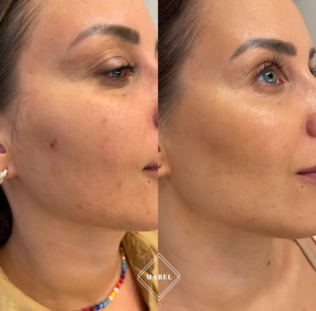 Profhilo hyaluronihappo, ihon kosteutus, esteettisethoidot Helsinki 4