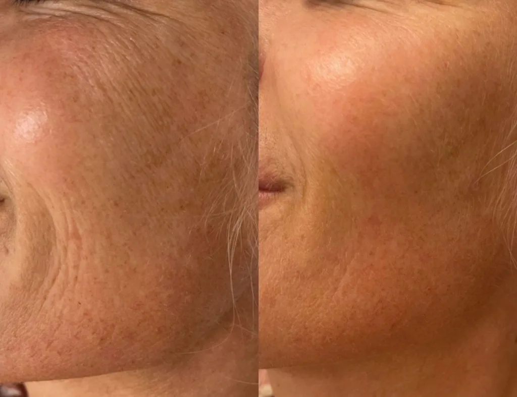 Profhilo hyaluronihappo, ihon kosteutus, esteettisethoidot Helsinki 6