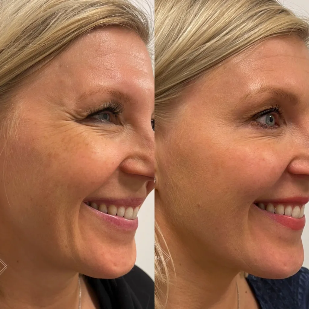 Profhilo hyaluronihappo, ihon kosteutus, esteettisethoidot Helsinki 7